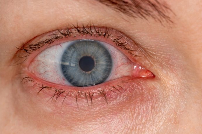 Reasons-for-eye-irritation-beyond-pink-eye